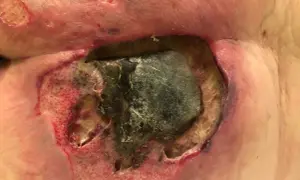 Głębokie odleżyny z czarną martwicą i zaczerwienionym, wilgotnym dnem. Widoczne oznaki stanu zapalnego wokół rany.