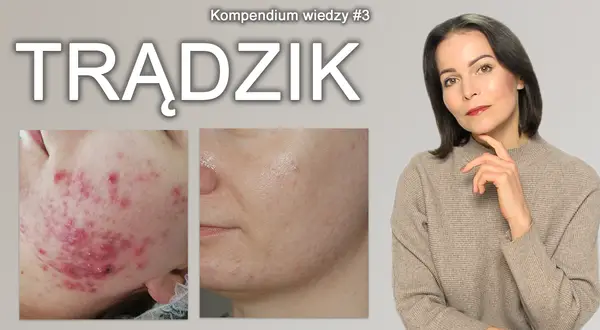 Czysta cera bez trądziku? Odkryj sekrety skutecznej profilaktyki
