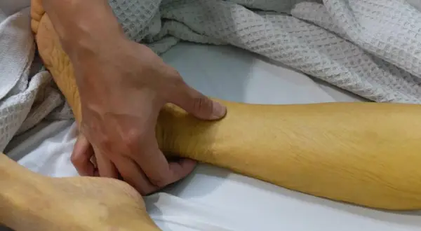 Żółta skóra nogi, wskazująca na podwyższony poziom bilirubiny w moczu.