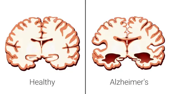 Porównanie mózgu zdrowego i z objawami choroby Alzheimera, która bywa nazywana cukrzycą typu 3. Widać zanik tkanki mózgowej.