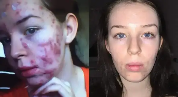 Przed i po leczeniu izotretynoiną: skóra z ciężkim trądzikiem i skóra po kuracji, czysta i gładka.