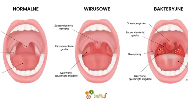 Sekrety profilaktyki anginy: Zbuduj odporność na cały rok