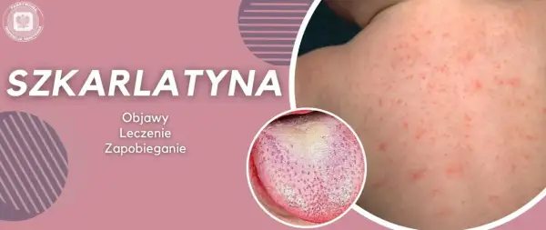 Szkarlatyna u dorosłych: czerwona wysypka na skórze i nalot na języku. Informacje o objawach, leczeniu i zapobieganiu.
