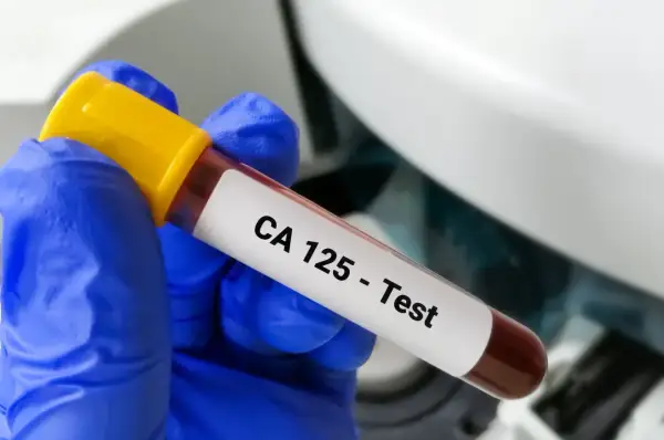 Rękawiczka w niebieskiej rękawiczce trzyma probówkę z krwią z etykietą "CA 125 - Test". To badanie pomaga wykryć pewne schorzenia.