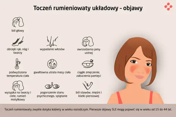 Objawy tocznia: bóle głowy, wysypka motylkowa, wypadanie włosów, owrzodzenia jamy ustnej, obrzęki, gorączka, utrata masy ciała, zmęczenie, problemy z pamięcią, bóle stawów i mięśni.